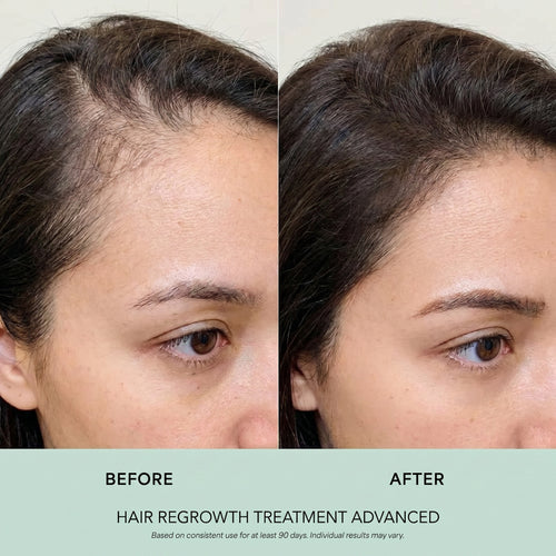 Hair Regrowth Treatment Advanced