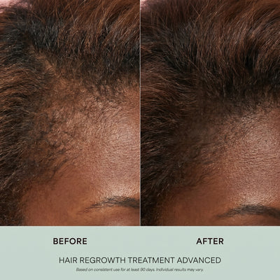 Hair Regrowth Treatment Advanced