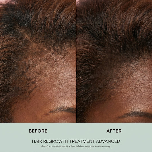 Hair Regrowth Treatment Advanced